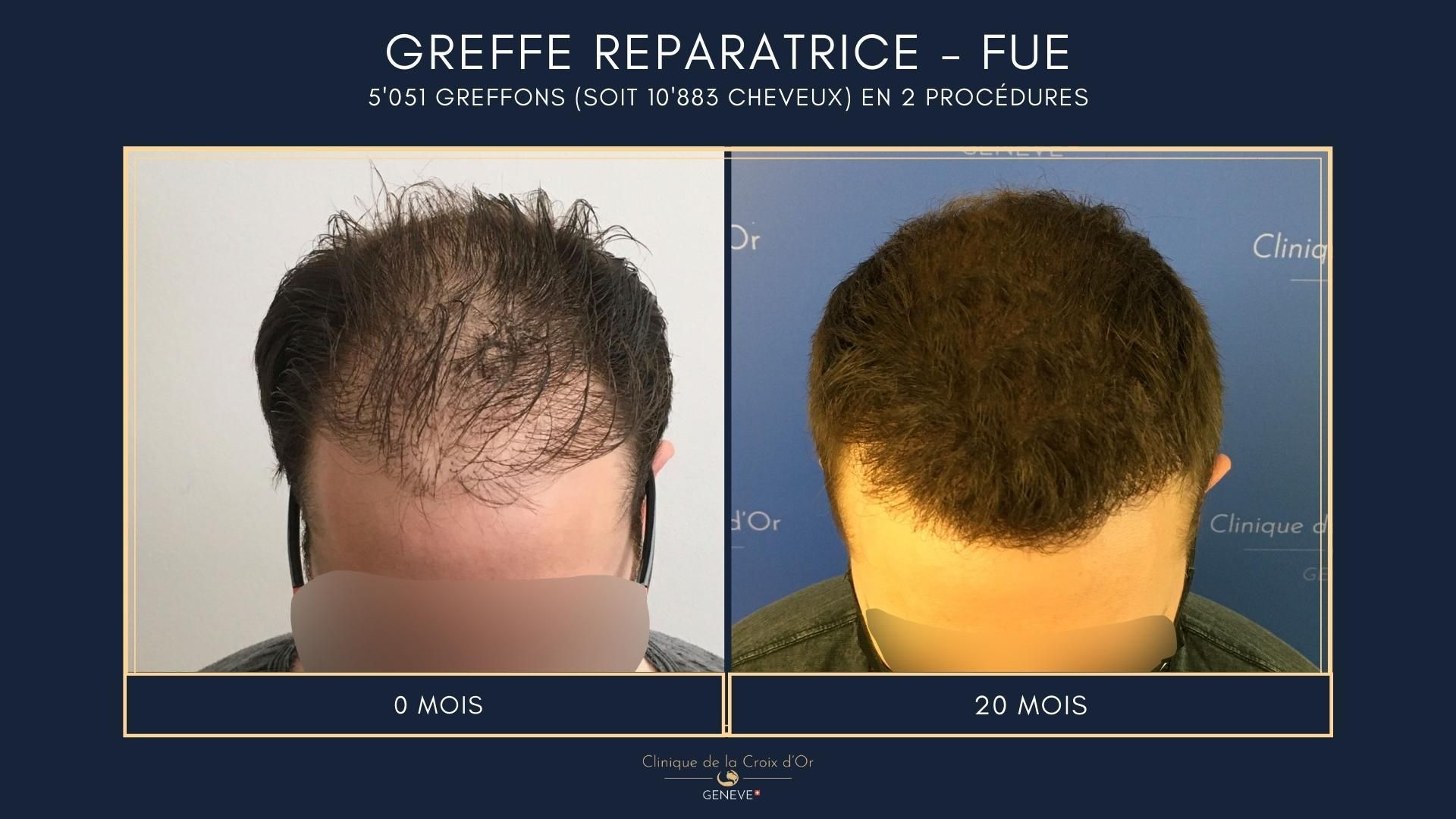Reparative or corrective hair transplant