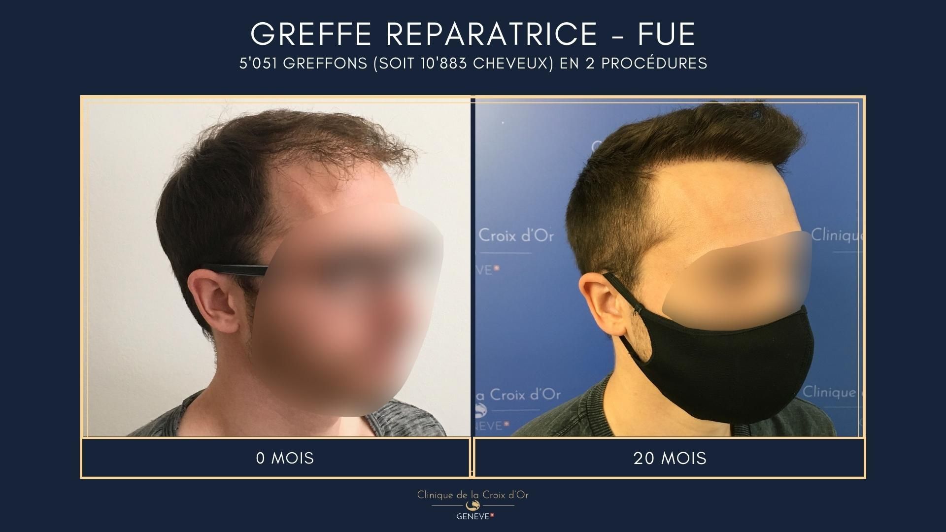 Reparative or corrective hair transplant