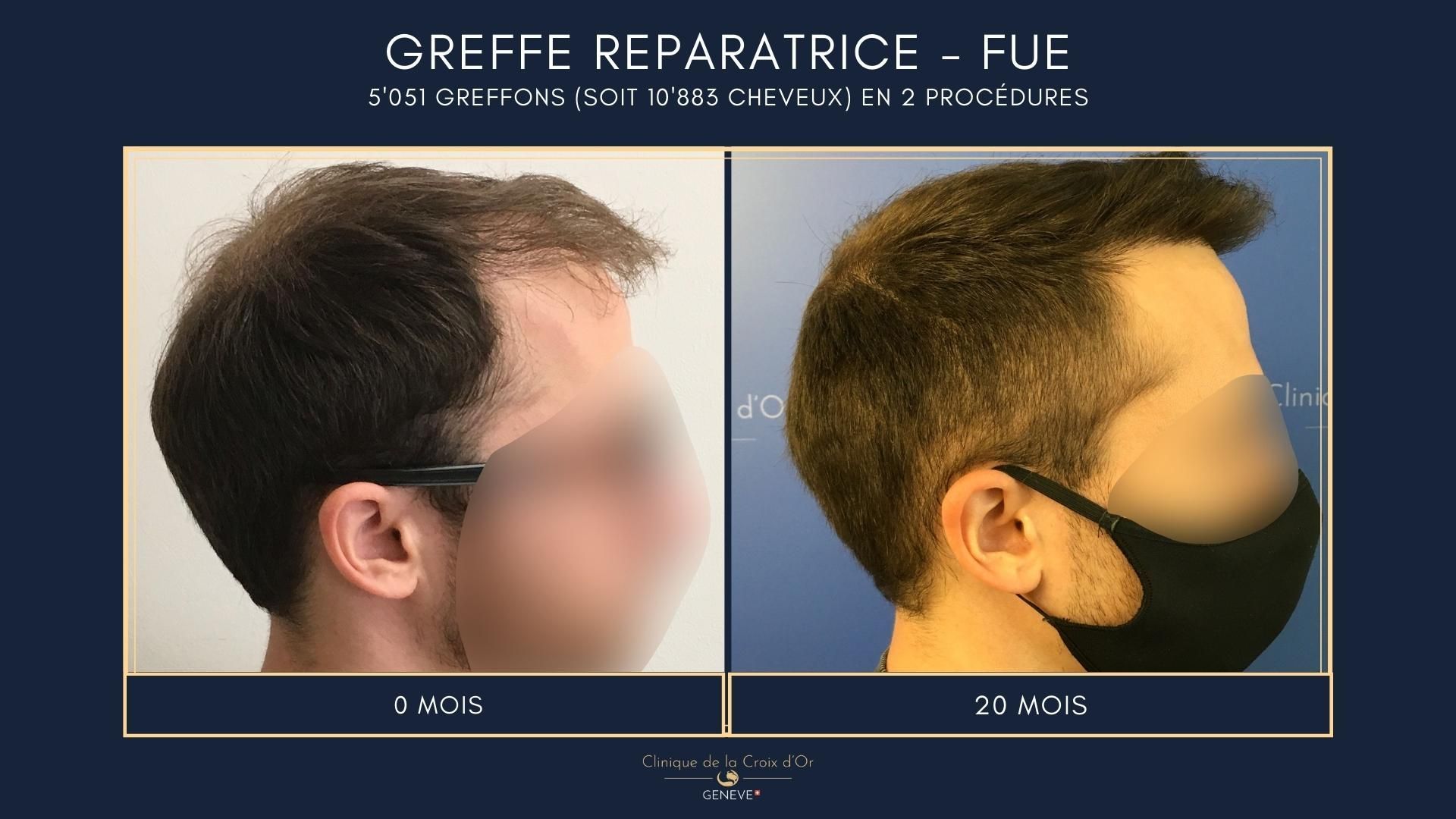 Reparative or corrective hair transplant