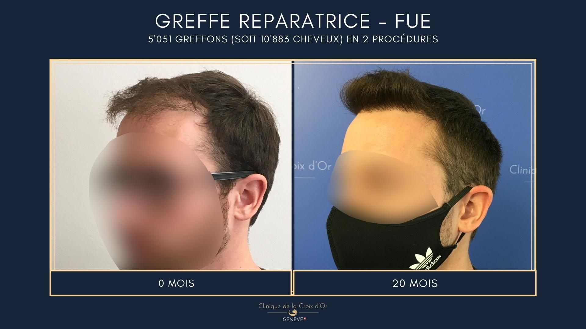 Reparative or corrective hair transplant