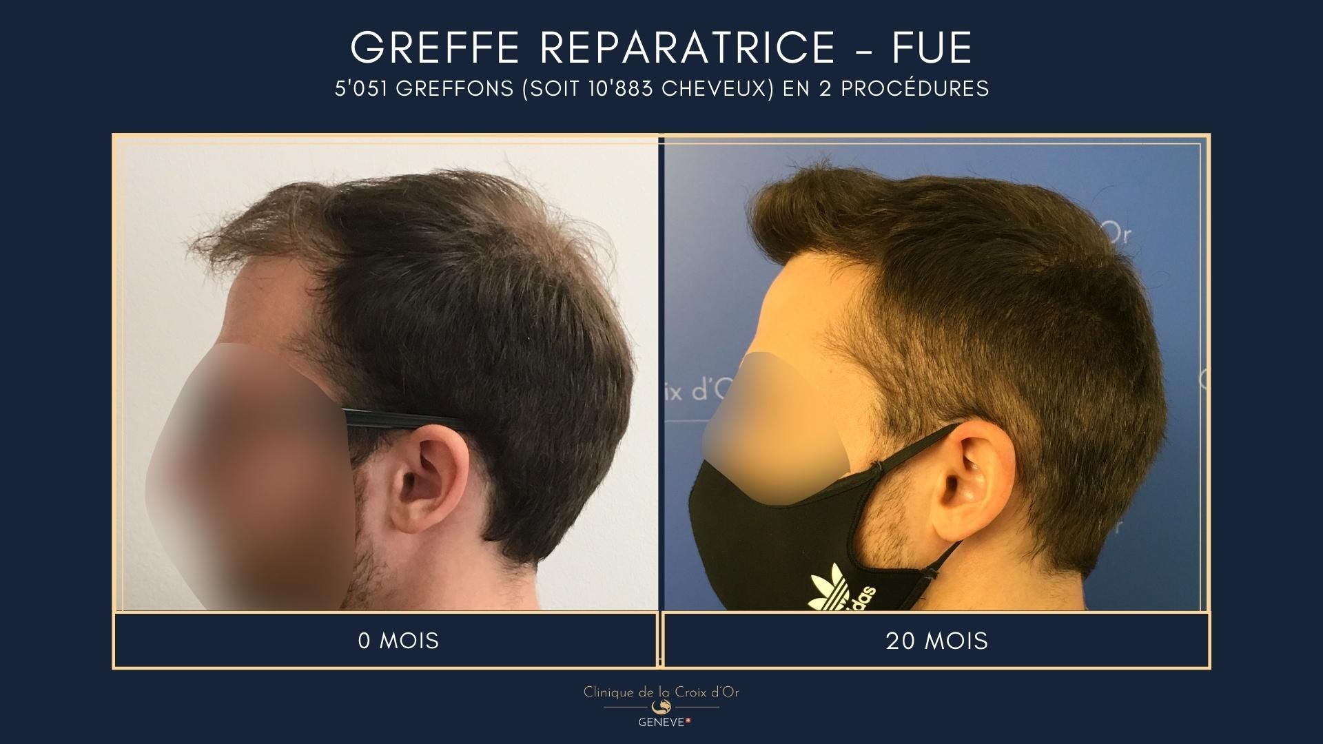 Reparative or corrective hair transplant