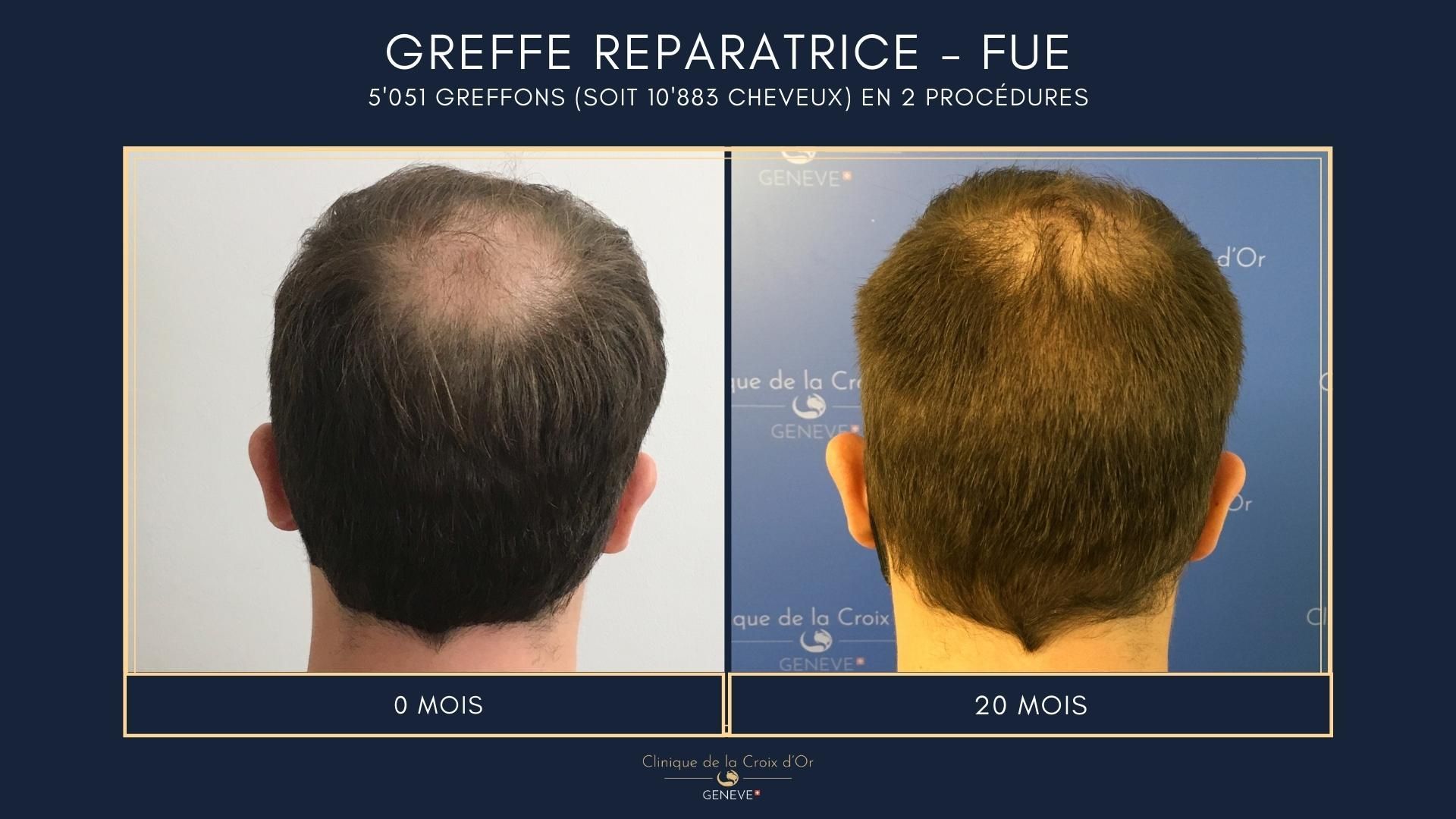 Reparative or corrective hair transplant