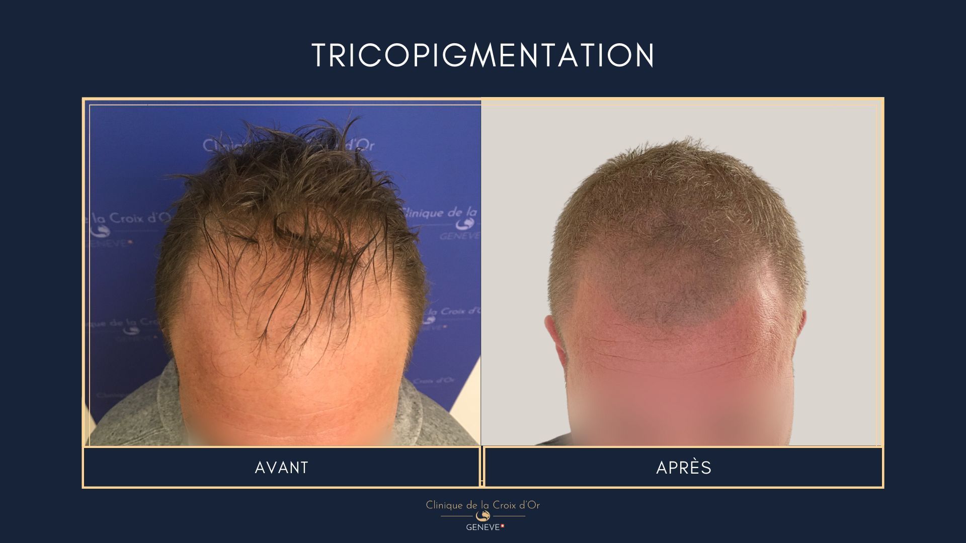 Tricopigmentation