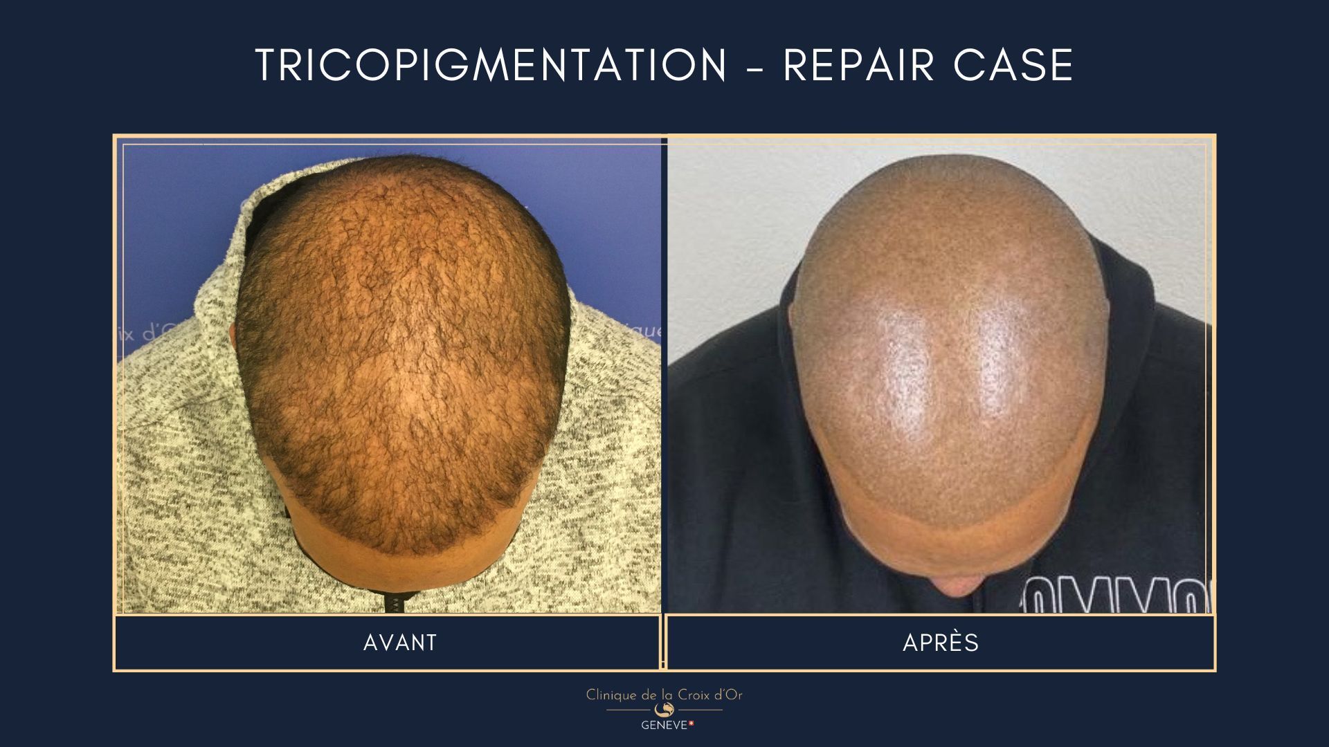 Tricopigmentation