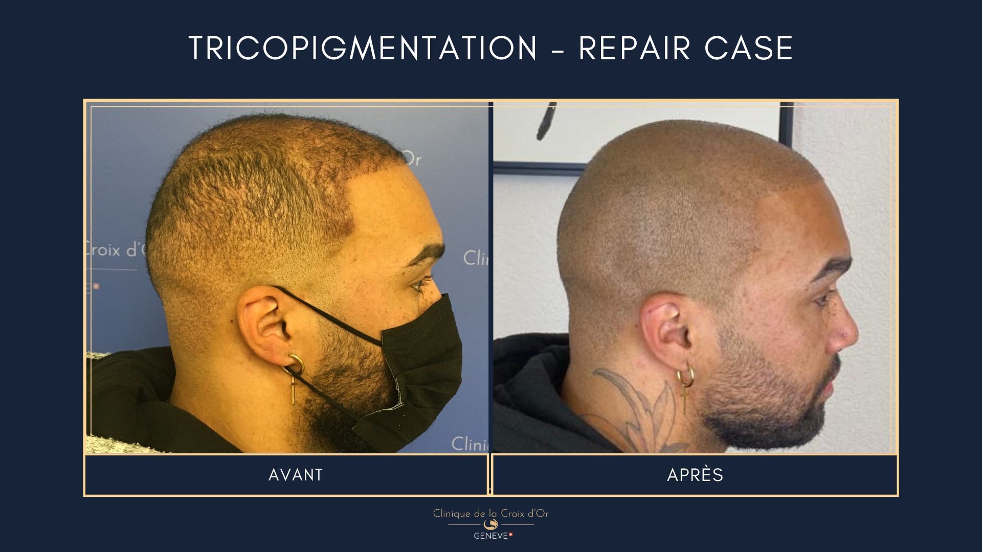 Tricopigmentation