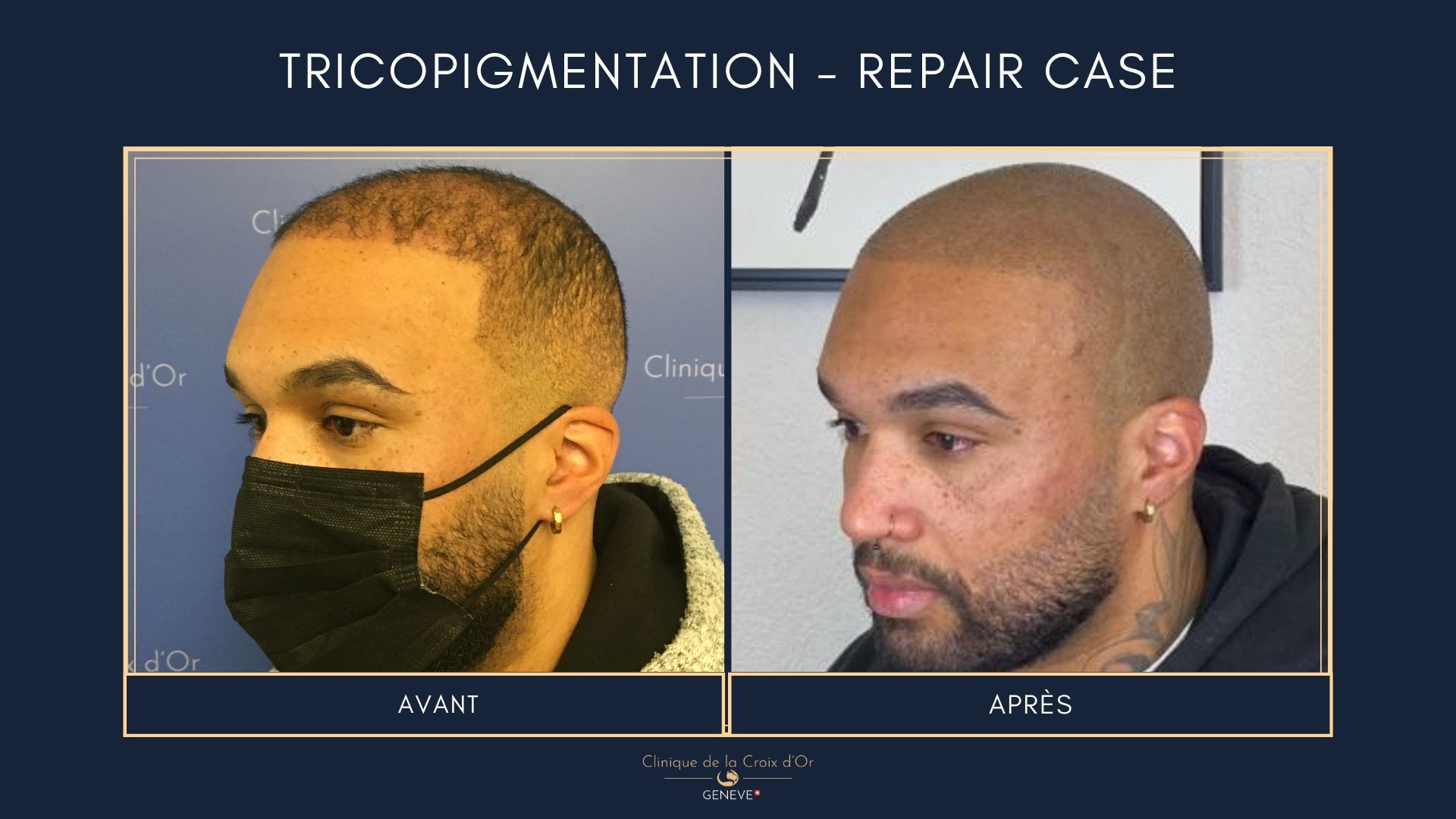 Tricopigmentation