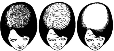 evolution capillaire cheveux femme alopecie calvitie